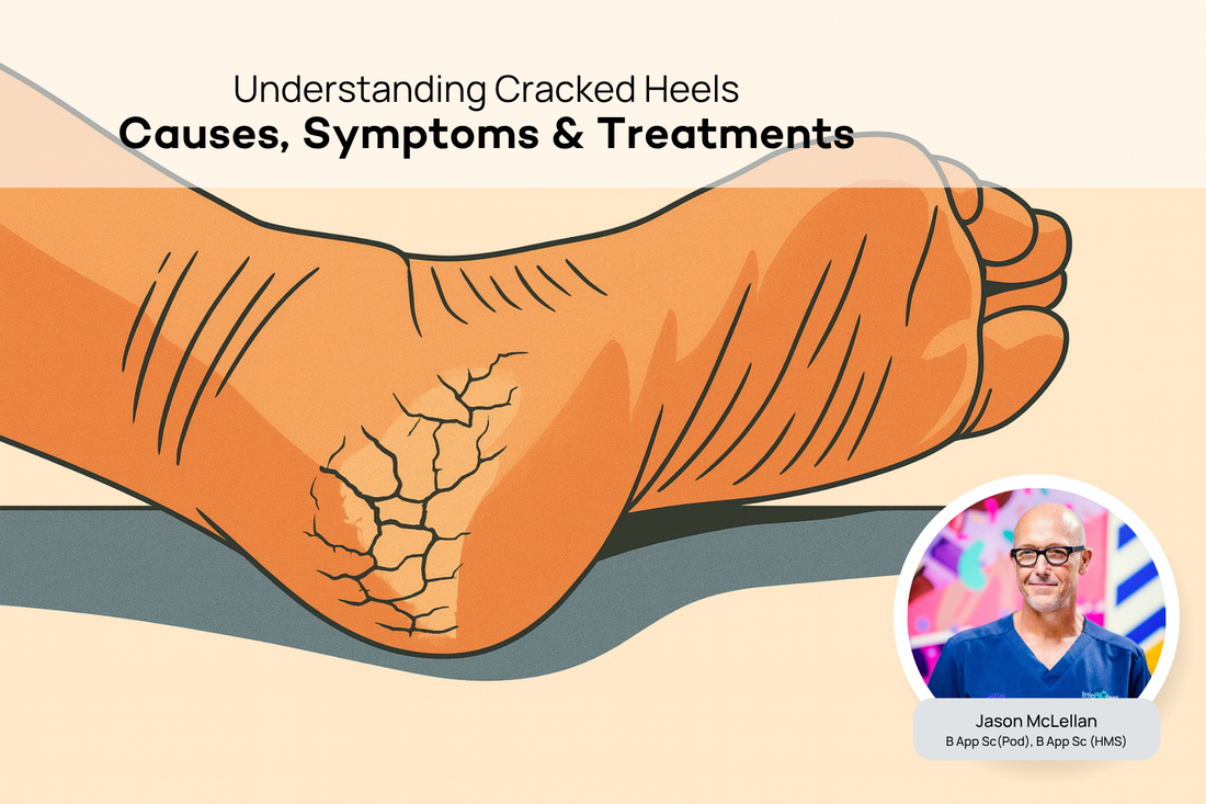 Cracked Heels - Podiatry Corner