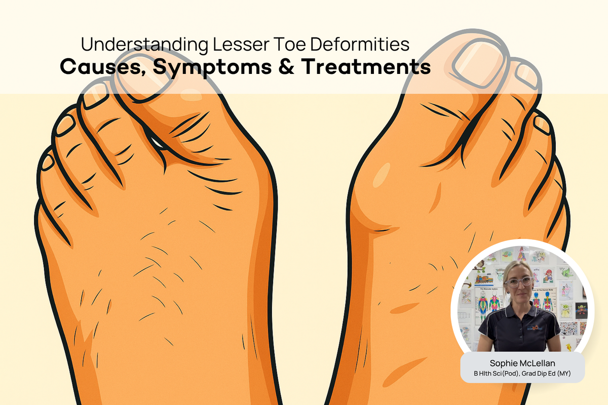 What are Lesser Toe Deformities? A Podiatrist Explains the Causes and ...